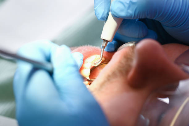 Best Emergency Wisdom Teeth Removal in Oak Grove, MN