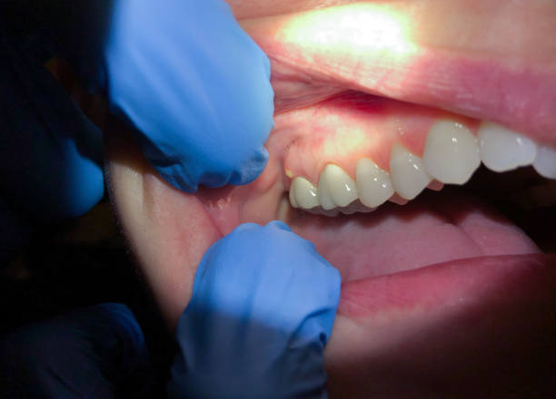 Best Emergency Dental Care for Broken or Chipped Teeth in Oak Grove, MN